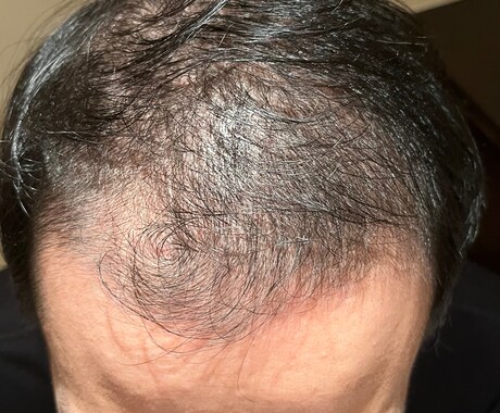 薄毛・AGAは改善できる！私が改善した方法教えます 私の実体験です。画像は私自身です！ イメージ1