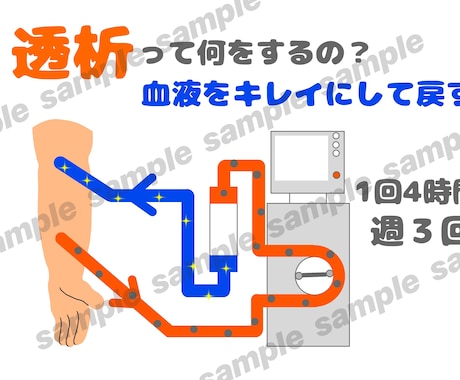 透析患説明がラクになる図解４枚セット作成します ３秒で伝わる！患者説明を楽にする図解 イメージ2