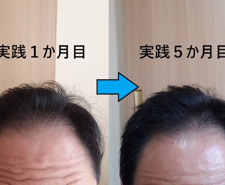 ミノキシジル無しでこの効果！写真のように改善します いつまでミノタブ、フィンペシアの副作用で消耗してるんですか？ イメージ2