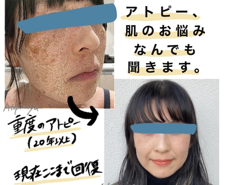 アトピーや敏感肌でお悩みの方、お話聞きます 食事、スキンケア、生活についてのお悩みなんでも