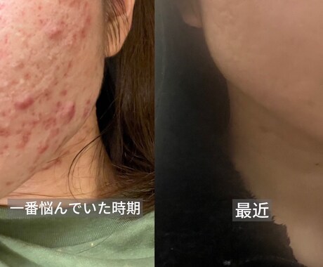 皮膚科で治らないニキビを改善した方法をお伝えします 生活習慣を見直して、ニキビができにくい肌を目指しませんか？ イメージ1