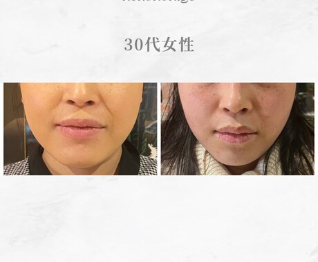 顔に鍼を打ってるだけ”から卒業できます お客様に変化を実感させる美容鍼の基礎からの打ち方 イメージ2