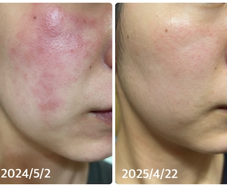 敏感肌さんのスキンケア相談のります ゆらぎやすいお肌の不安、ひとつずつ一緒に整理しましょう イメージ1