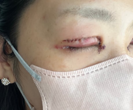 眼瞼下垂（二重整形）手術後の合併症　後遺症相談ます 2年半の生活変化と私の乗り越え方 イメージ2