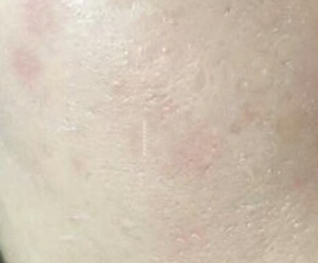 家でクレーターを完全に治す方法教えます 肌の深いクレーターを短期間で治す方法教えます！ イメージ2