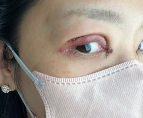 眼瞼下垂（二重整形）手術後の合併症　後遺症相談ます 2年半の生活変化と私の乗り越え方 イメージ1
