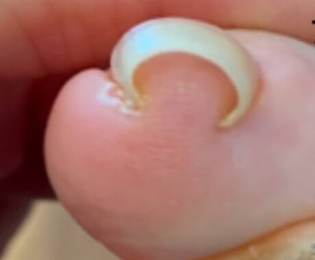 巻き爪様子がおかしい爪　足の相談お受けします 病院はコワい気になる足の事写真を送るだけで改善したい！ イメージ1