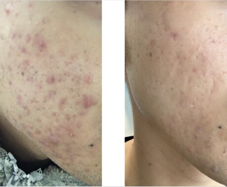 お悩みの肌トラブルを解決いたします 自分の【ニキビ肌激変経験】から肌トラブルのお悩み乗ります イメージ1