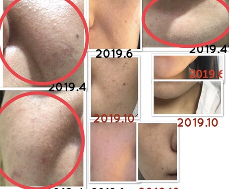 美肌へ肌悩みのカウンセリング➕肌改善方法教えます プロ資格講師自宅ケア改善指導ニキビ肌荒れ改善法伝授 イメージ2