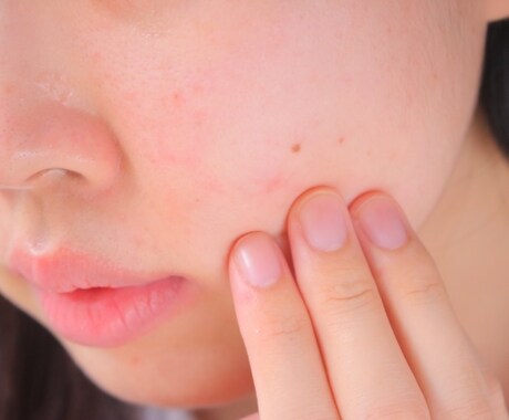 アトピー相談受けます 私流のアトピーとの付き合い方伝授します！ イメージ2