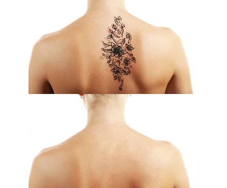 【画像修正・ レタッチ】Tattoo(刺青)・アザ・手術痕などを消去♪ イメージ1