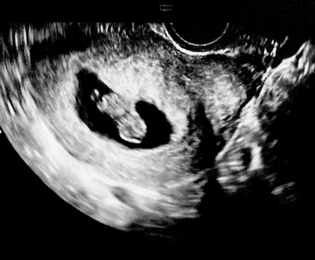 エコーにて最速妊娠6週からの性別予測をします 産婦人科、超音波専門医がラムジーメソッドにて性別予測！ イメージ1
