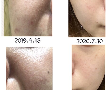 美肌へ肌悩みのカウンセリング➕肌改善方法教えます プロ資格講師自宅ケア改善指導ニキビ肌荒れ改善法伝授 イメージ1