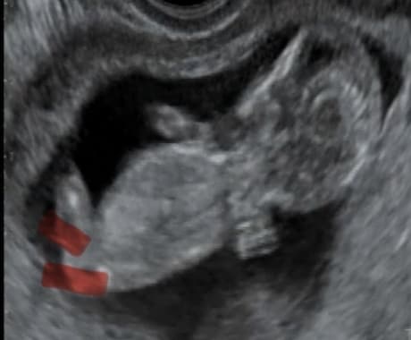 赤ちゃんのエコー動画から性別判定します 10〜13週くらいのベビーナブ判定 イメージ2