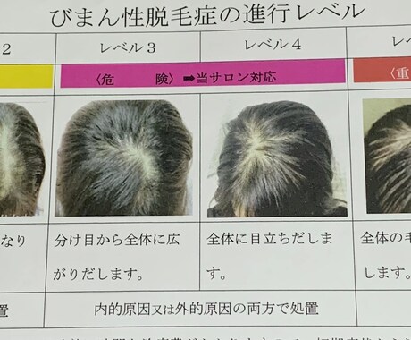 薄毛のあなたに寄り添います プロ心理カウンセラーが、本格発毛アドバイスをします。 イメージ2