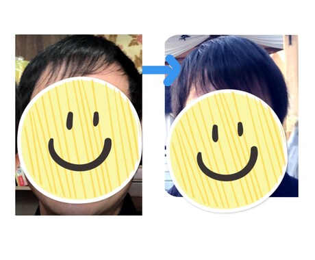 発毛経験、プロペシアの使用体験教えます 薄毛に悩んでプロペシアの使用を考えたことはありませんか？ イメージ1