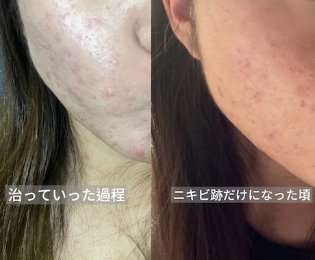 皮膚科で治らないニキビを改善した方法をお伝えします 生活習慣を見直して、ニキビができにくい肌を目指しませんか？ イメージ2