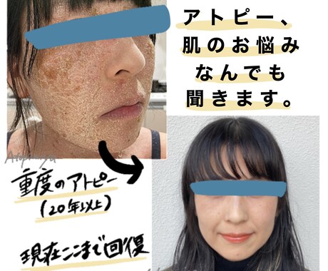 誰にも話せないアトピーの悩み聞きます経験談話します 20年間アトピーに悩み脱ステロイドを経験し、改善したOLです イメージ1