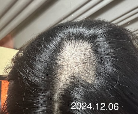 抜毛症専門！あなたの気持ちに寄り添います 長年抜毛症と戦ってきました。共に頑張りましょう。 イメージ2