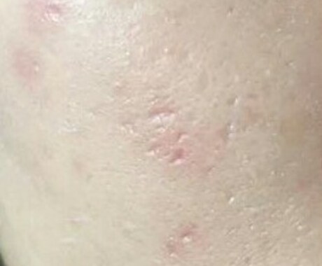 家でクレーターを完全に治す方法教えます 肌の深いクレーターを短期間で治す方法教えます！ イメージ1