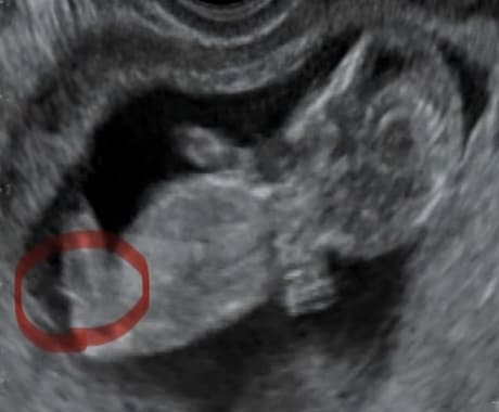赤ちゃんのエコー動画から性別判定します 10〜13週ベビーナブ判定、それ以降は外性器による判定 イメージ1