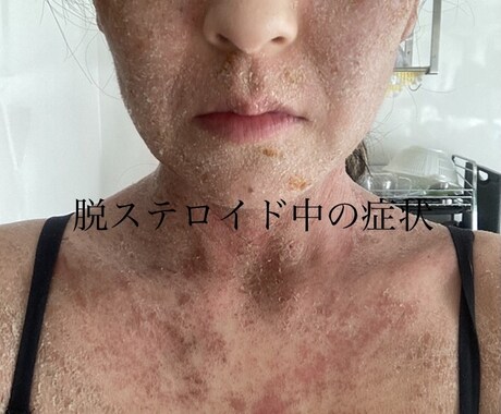 誰にも話せないアトピーの悩み聞きます経験談話します 20年間アトピーに悩み脱ステロイドを経験し、改善したOLです イメージ2