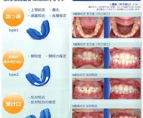 子供の歯並び気になっている方お話伺います 本格的な矯正の前にプレオルソ。お安くできます イメージ2