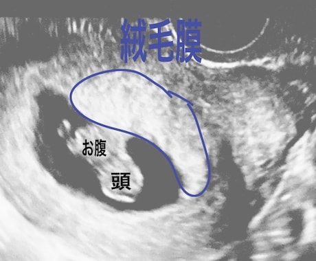エコーにて最速妊娠6週からの性別予測をします 産婦人科、超音波専門医がラムジーメソッドにて性別予測！ イメージ2