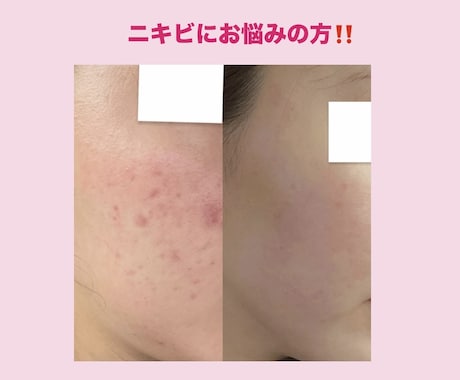 ニキビ肌を克服した私がやって良かったことを教えます 実際にやってよかったことなど、私の経験をありのまま伝えます。 イメージ1