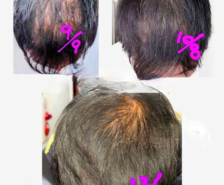 薄毛の悩み、相談にのります 諦めないで！誰でもできる薄毛予防対策 イメージ1