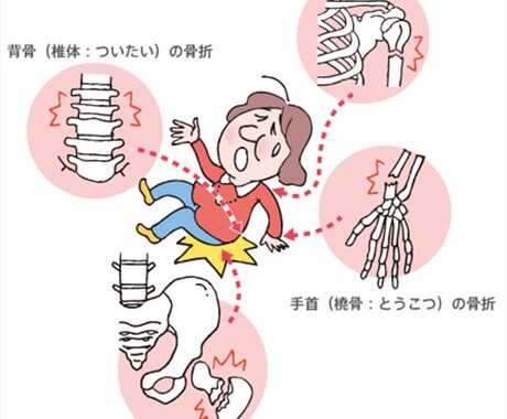 骨粗鬆症の治療薬について教えます 骨粗鬆症を多く扱う病院の薬剤師です。 イメージ1