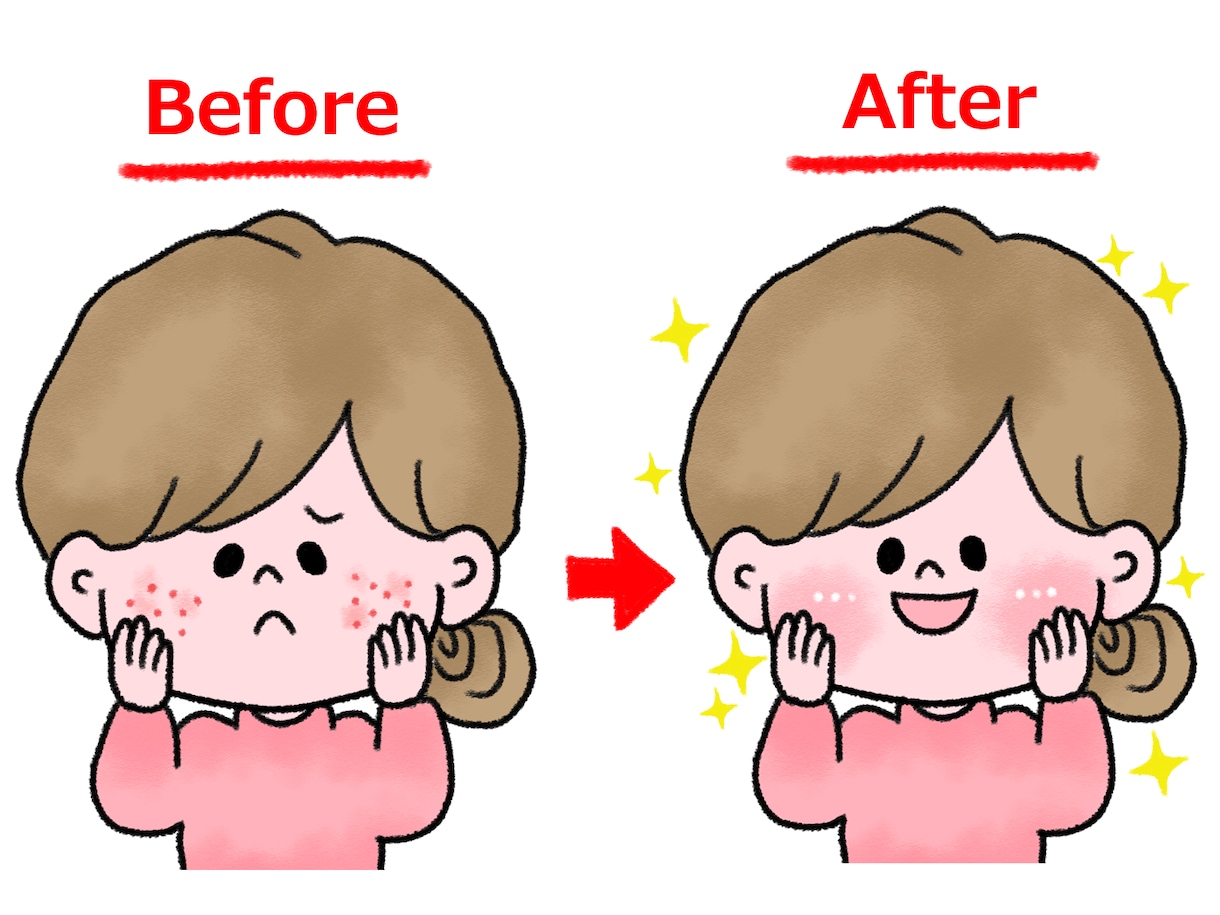 ニキビのお悩み解決法をお伝えします 長年悩んできたニキビが治りできにくい肌をつくる方法 イメージ1