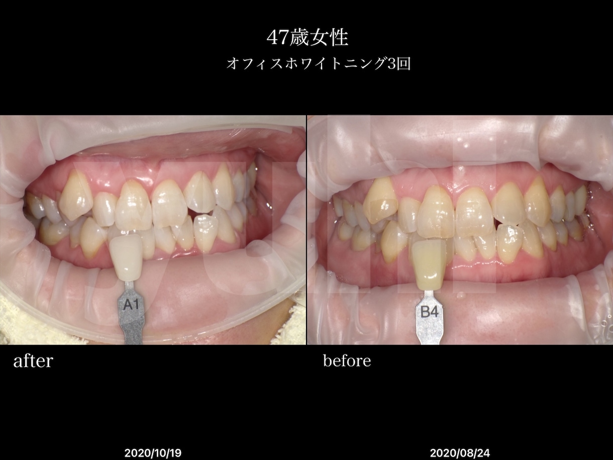 ホワイトニングの説明をします 種類があります！自分にピッタリな適切なホワイトニングを選択 イメージ5