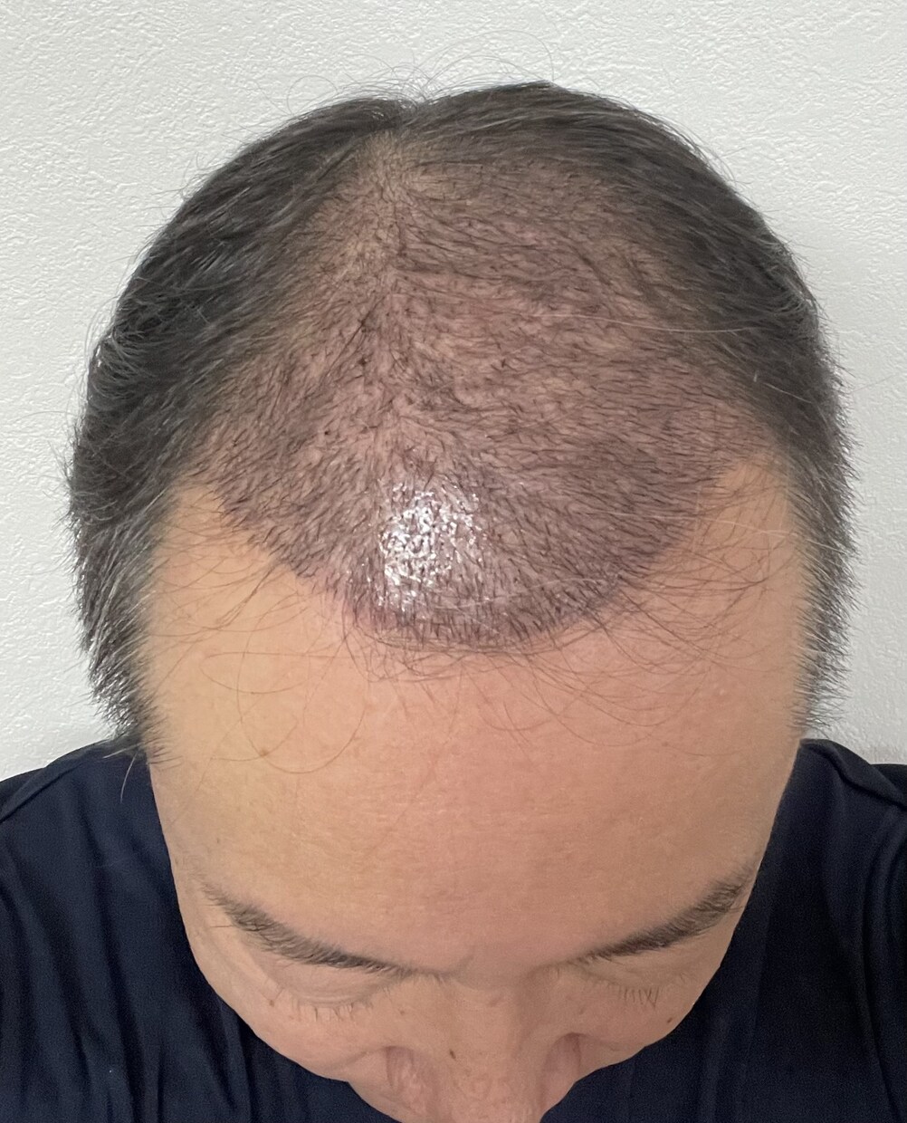 植毛について、実体験に基づきアドバイスします 育毛剤、頭皮ケアはほぼ無意味！AGA治療薬は一生継続必要 イメージ4