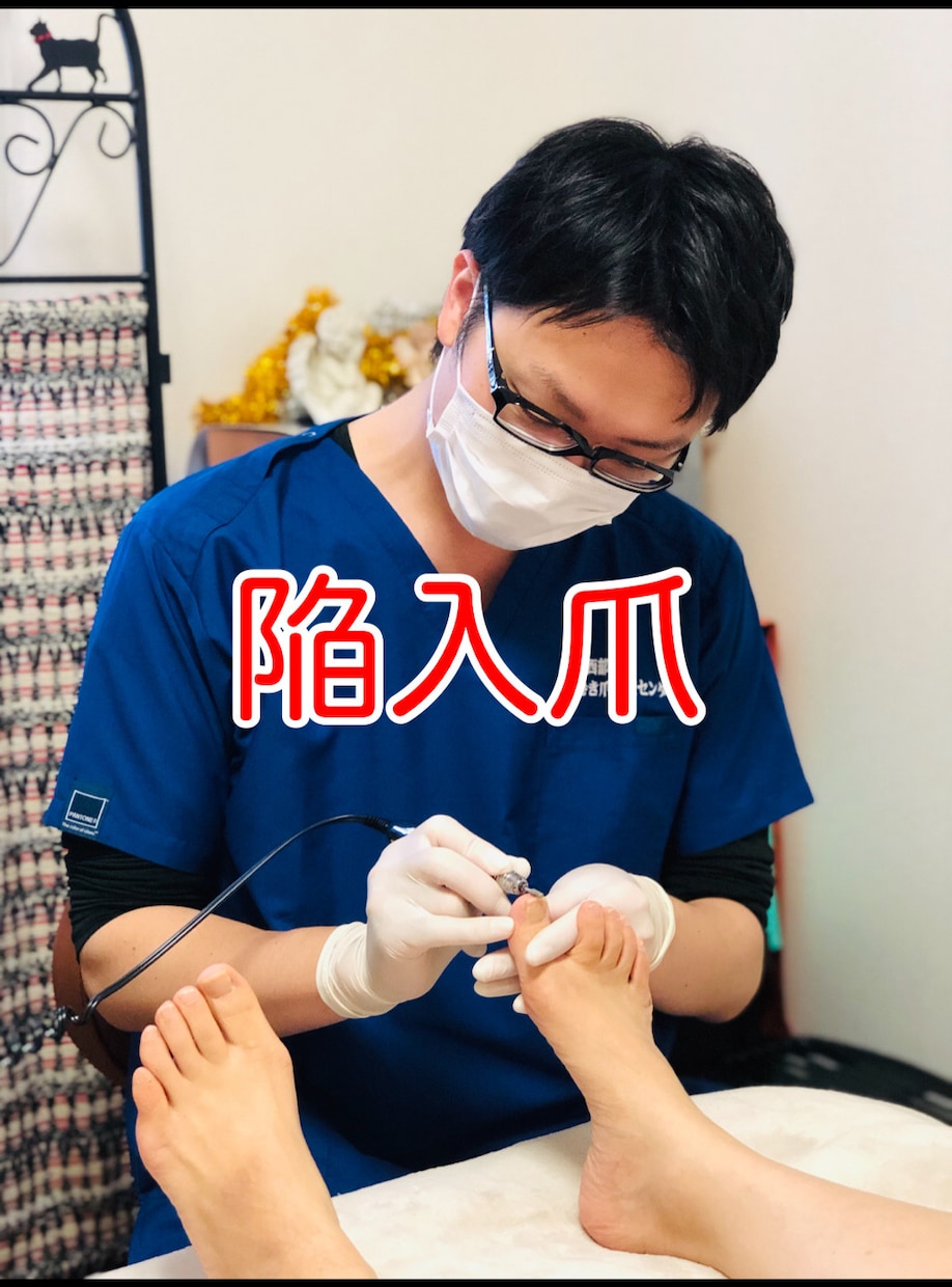 陥入爪で悩んでいる方へ⭐️実績あるプロがお話します どなたでも大歓迎✨陥入爪に関してのご相談お任せください❗️✨ イメージ1