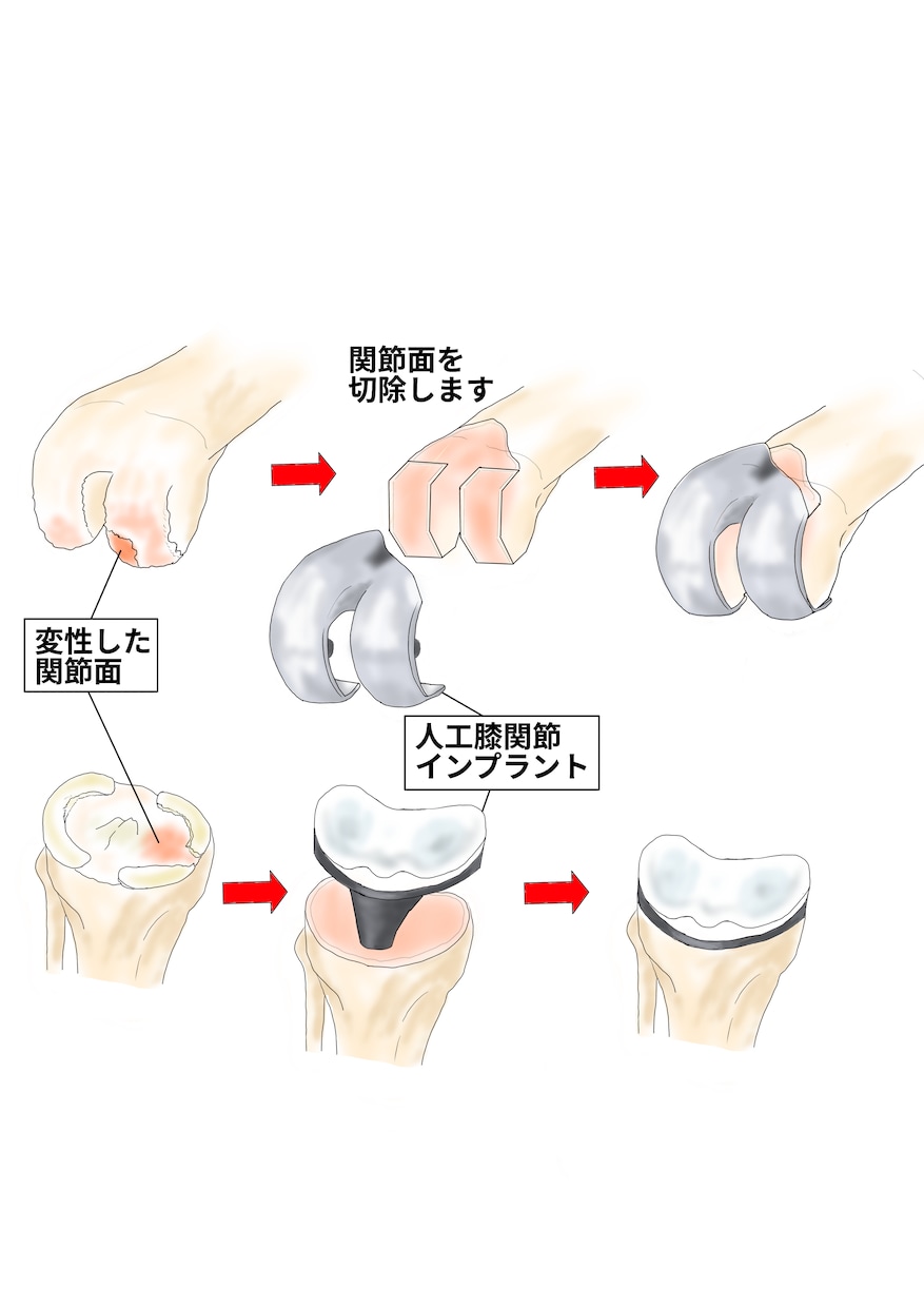 整形外科専門医が医療イラストを描きます 論文用シェーマや患者説明用イラストなどに！ イメージ3
