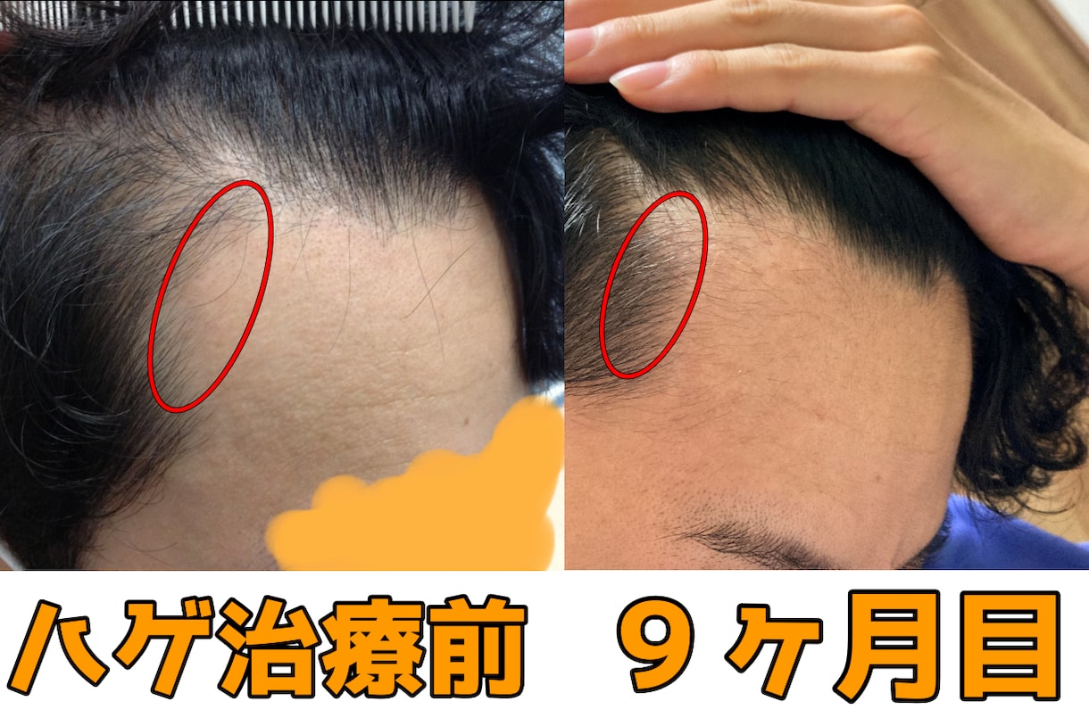 AGA治療歴3年！薄毛の悩みを解決致します プロの薄毛治療ライターである私が、あなたに最適な方法をご提案 イメージ2