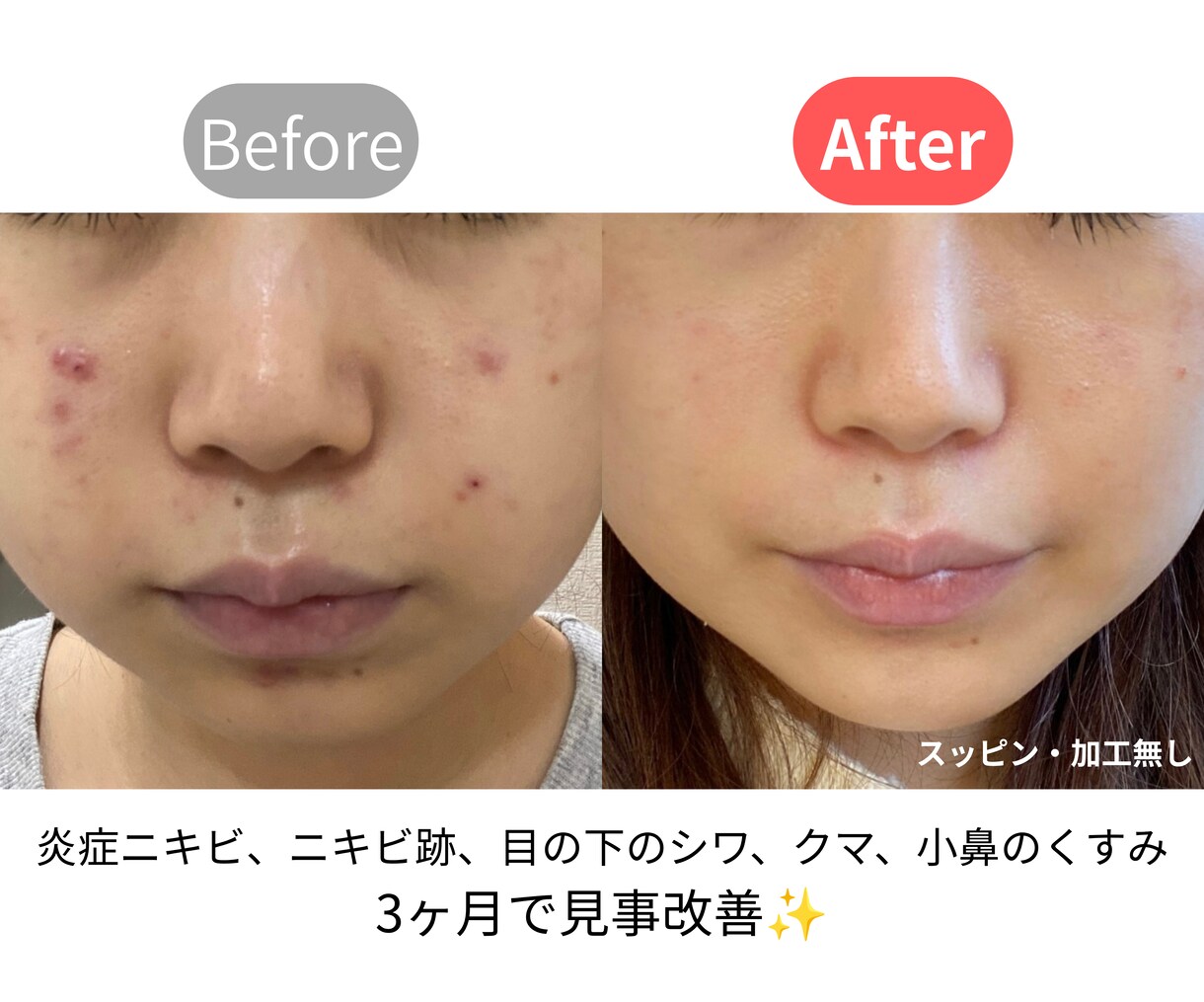 30代からのニキビケア教えます 30代のニキビ、ニキビ跡悩みさん必見！すっぴんがキレイになる イメージ1