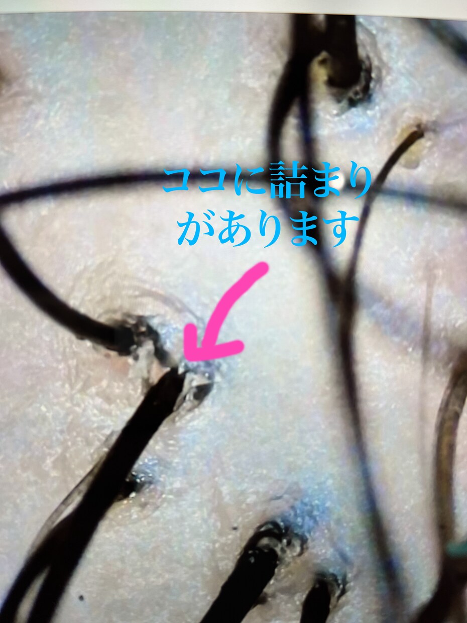 頭皮のかゆみ、フケのお悩み解消伺います 年間1000人の頭皮を診断している美容師です イメージ2