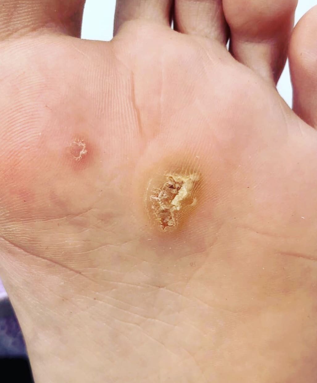 魚の目で悩んでいる方へ⭐️実績あるプロがお話します どなたでも大歓迎✨タコ魚の目に関してのご相談お任せ下さい❗️ イメージ9