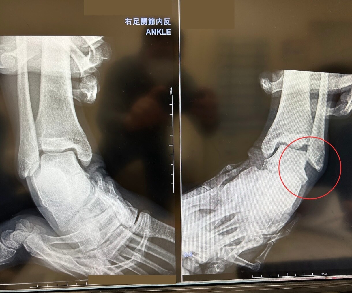 足首の捻挫を頻繁に繰り返す強化プログラム作成します 何度も繰り返し捻挫する問題には必ず原因があり〇〇を強化する事 イメージ9