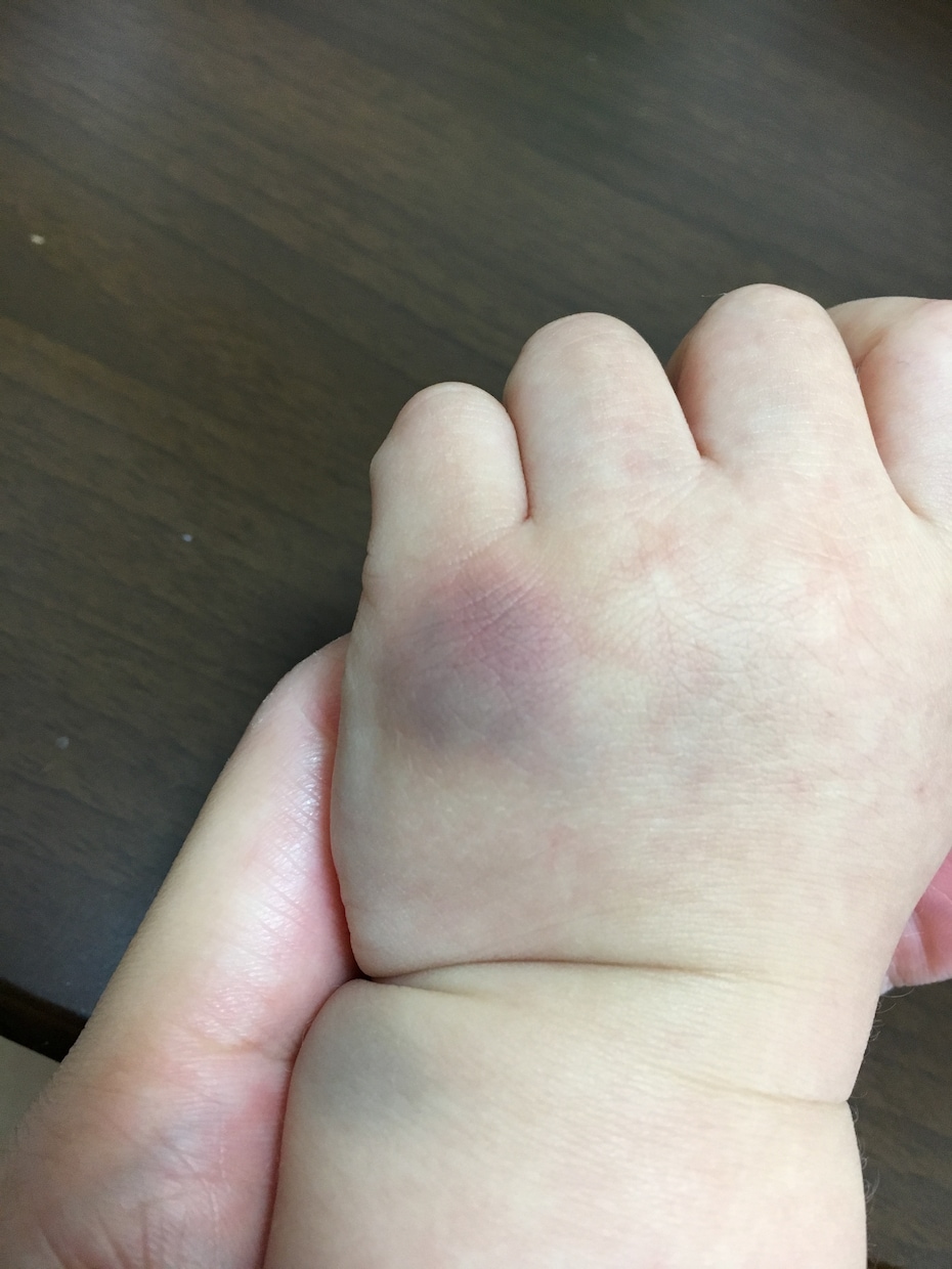 血小板減少性紫斑病になったら…お教えします 血小板減少性紫斑病ってなに？不安なご両親様へ イメージ1