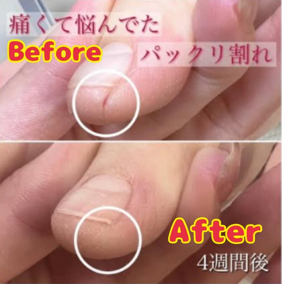 パックリ、ヒビ割れの治す方法をお教えします ひび、パックリ割れ痛いですよね。しっかり根完治しましょう。 イメージ3