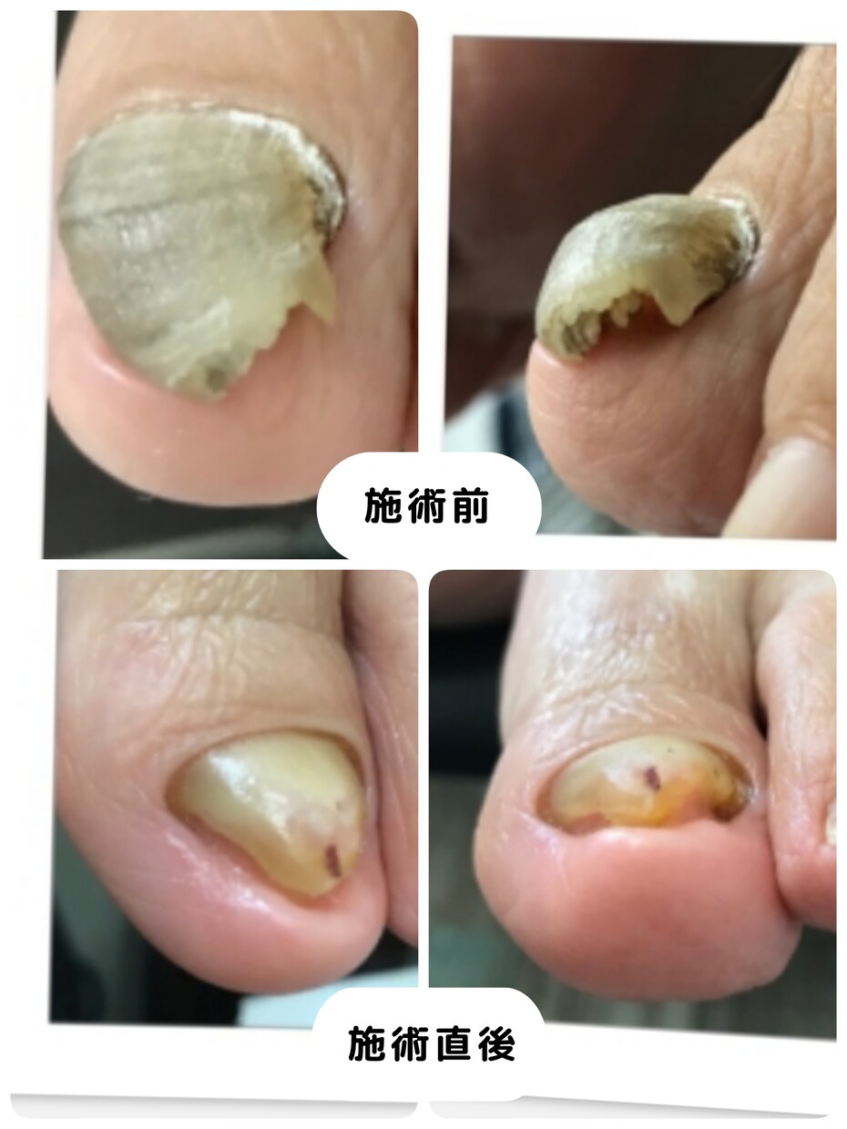 巻き爪様子がおかしい爪　足の相談お受けします 病院はコワい気になる足の事写真を送るだけで改善したい！ イメージ4