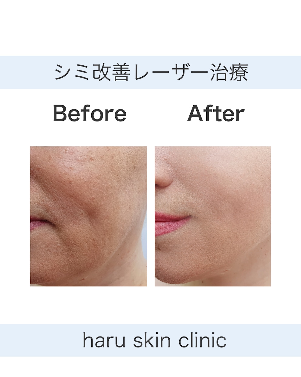 美容クリニック向けSNS投稿デザイン作成します 清潔感のあるデザインで施術紹介・お知らせに最適 イメージ2