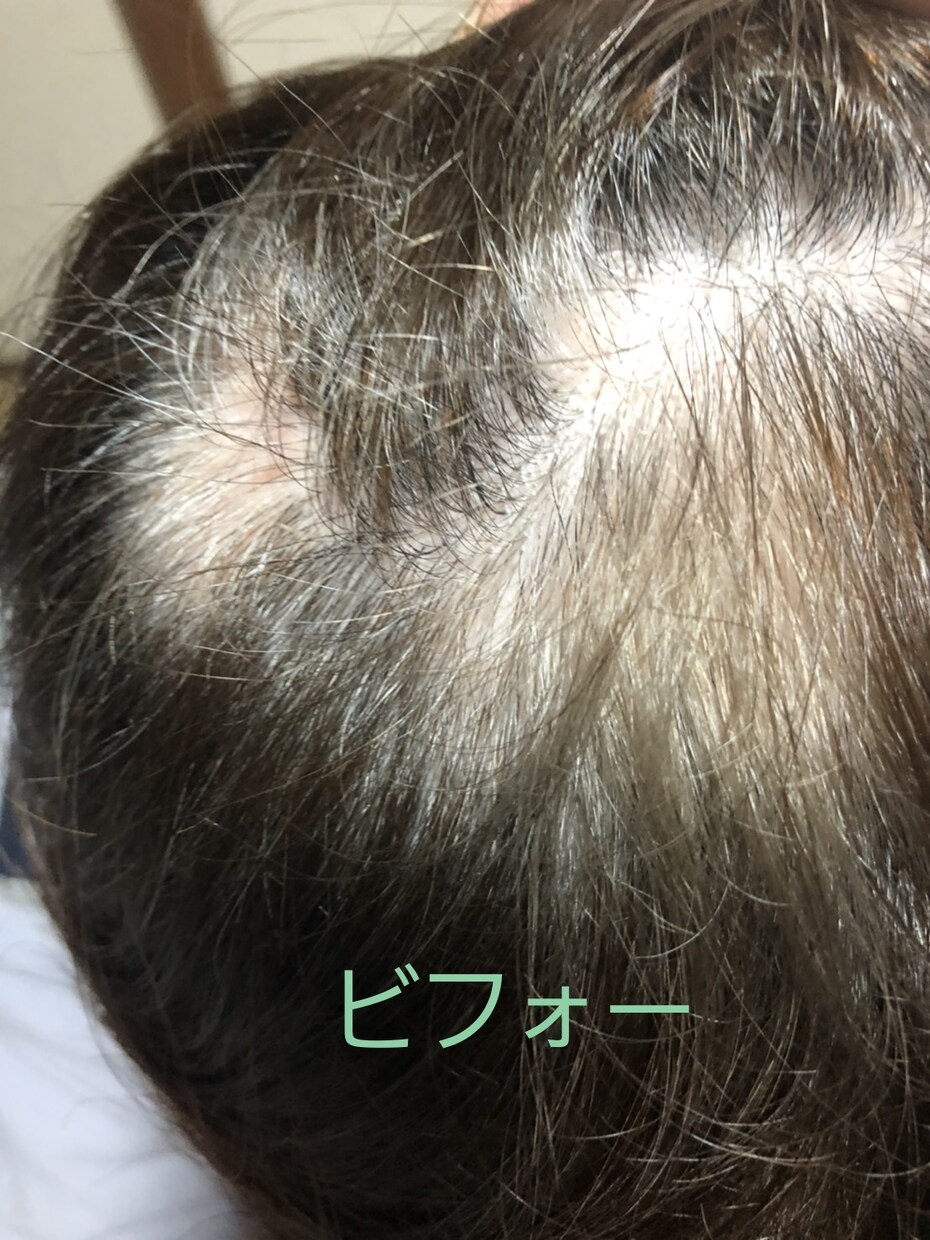 体験談！薄毛体験談語ります 薄毛対策の体験談を語ります！ビフォーアフター写真有り！ イメージ2