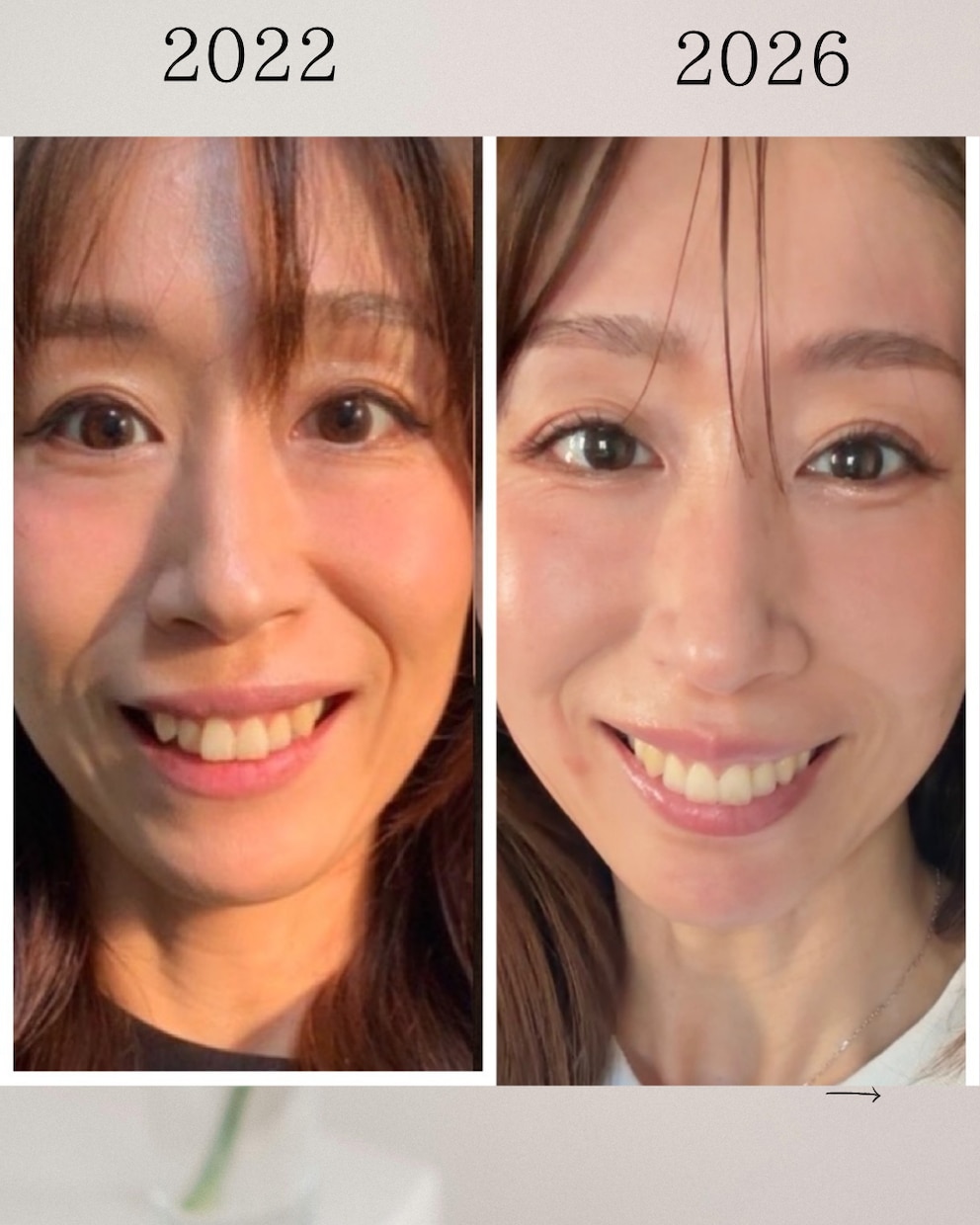 老け見え対策を表情筋レッスンをします たるみ・ほうれい線を自己流から卒業 イメージ1