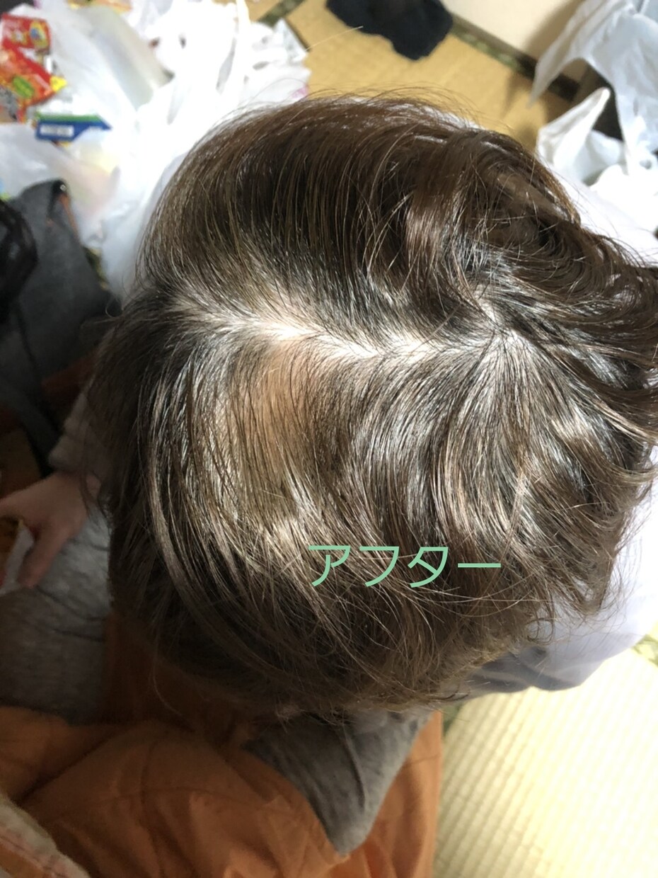体験談!薄毛体験談語ります 薄毛対策の体験談を語ります!ビフォーアフター写真有り! イメージ1
