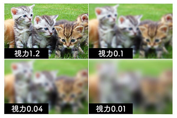 ICL経験者が手術のリアルな痛みや流れを教えます 新宿近視クリニック経験者と本音で話せるICLのリアルについて イメージ5