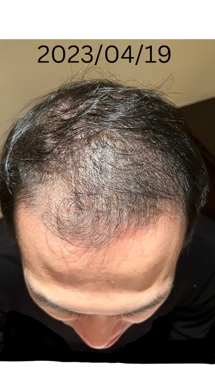 薄毛・AGAは改善できる！私が改善した方法教えます 私の実体験です。画像は私自身です！ イメージ1